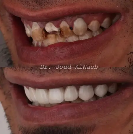 Patient came to the clinic and he had story to exposure car accidents 