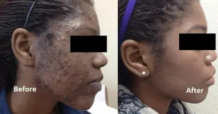 Be among the first 10 people to PAY for facial within the next 3 days and pay 4k