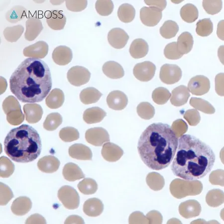 Step1 quiz time!

A 13-year-old girl is brought to the physician by he