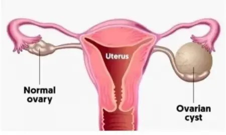 PERMANENT TREATMENT FOR OVARIAN CYSTS WITHOUT SURGERYOPERATION
 Ovarian cysts a