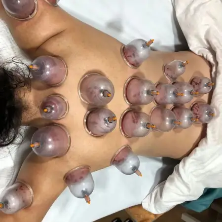 Le saignement du dos est lune des thrapies de saigne de la mdecine tradi