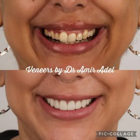 This Patient Came to Dr Amir Adel complaining of Gummy Smile, Malocclusion and yellow teeth