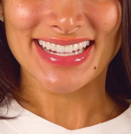 Working hard to make the smile piece of art. Full case of veneers. doctorduval duval c