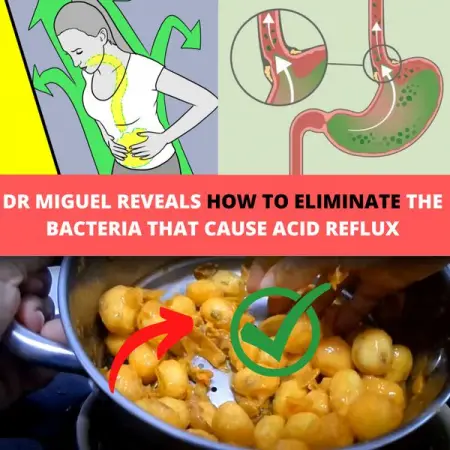 Since my youth I have suffered with
reflux... I couldnt eat what I
liked, had s