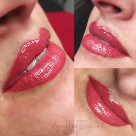 Blush Lips is one of our Favorite procedures. We use the latest technology n